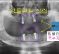 파노-마그네틱_장착