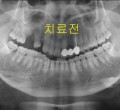 파노-치료전